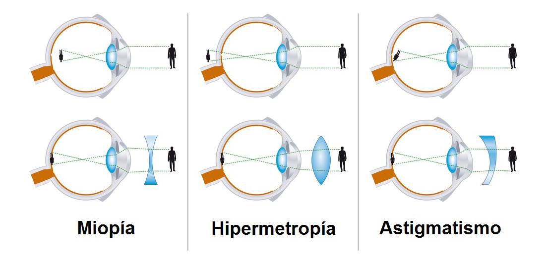Tipos de Ametropias